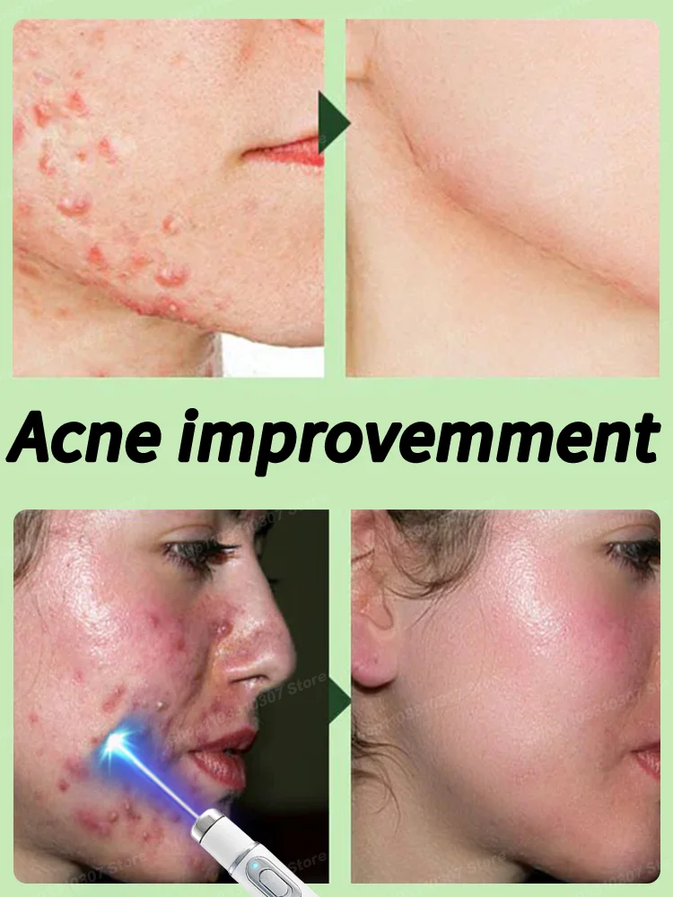 

Acne Facial Serum Pore Shrinking Skin Care Against Face Pimple