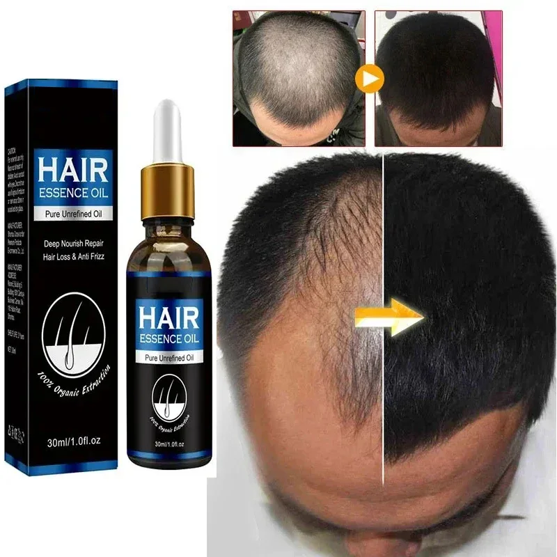 Hair Growth Oil Effective Rapid Repair Fast Baldness Postpartum Hair Loss Follicles Hereditary Loss Hair Care Solution view 5