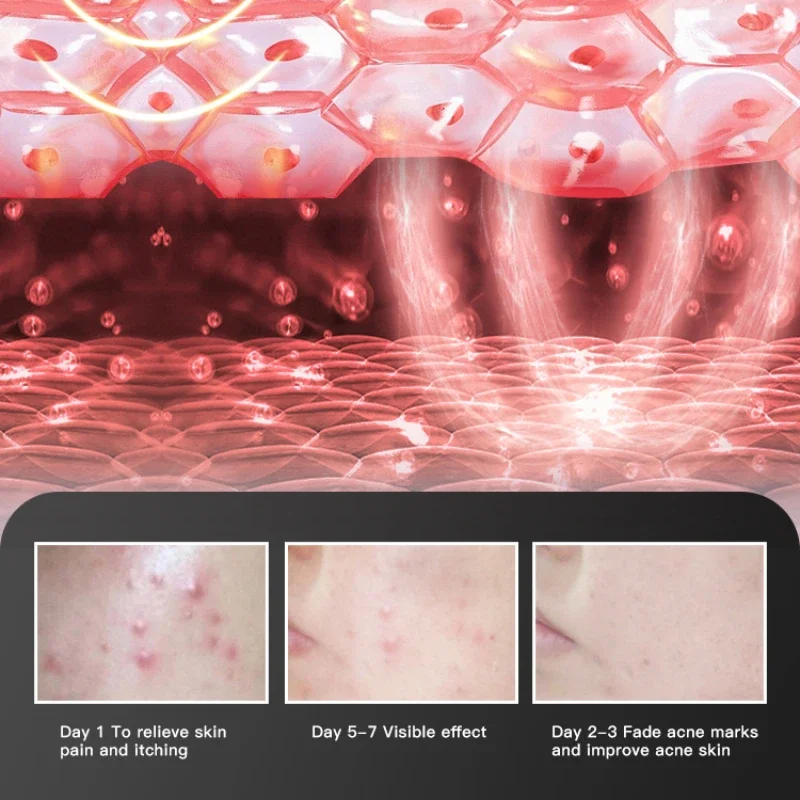 ozone plasma pen acne treatment device beauty instrument Blemish Removal Dead Skin Removal Skin Rejuvenation Skin Mouisture