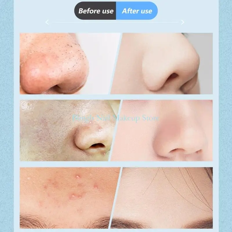 28TA Advanced Blackhead Vakuum -Gerätsschwarzkopf -Entferner und 6 Saugköpfe