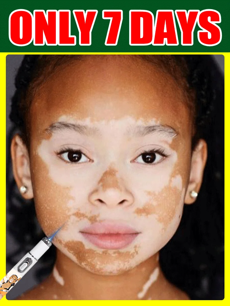 

Модернизированное 2-е поколение Vitiligo ремонт Vitiligo uickly