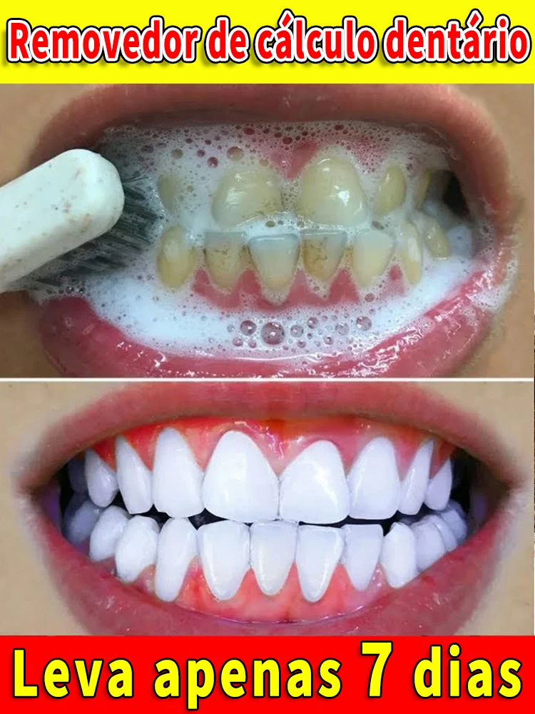 Removedor de cálculo Dental, eliminación de mal aliento, blanqueamiento de dientes, pasta de dientes, brillo, prevención de la Periodontitis,