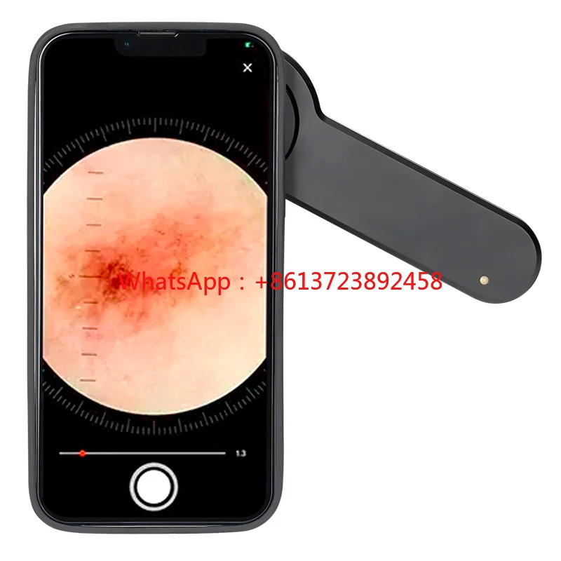 Medical Microscope Dermascope for Skin Lesion Diagnosis