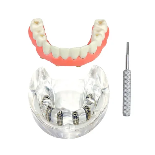 Imagen 2 del producto Modelo de implante Dental, simulación de restauración de mandíbula superior/inferior, sobredentadura, extraíble, 4/6 tornillos de implantes, modelo de demostración de enseñanza Dental