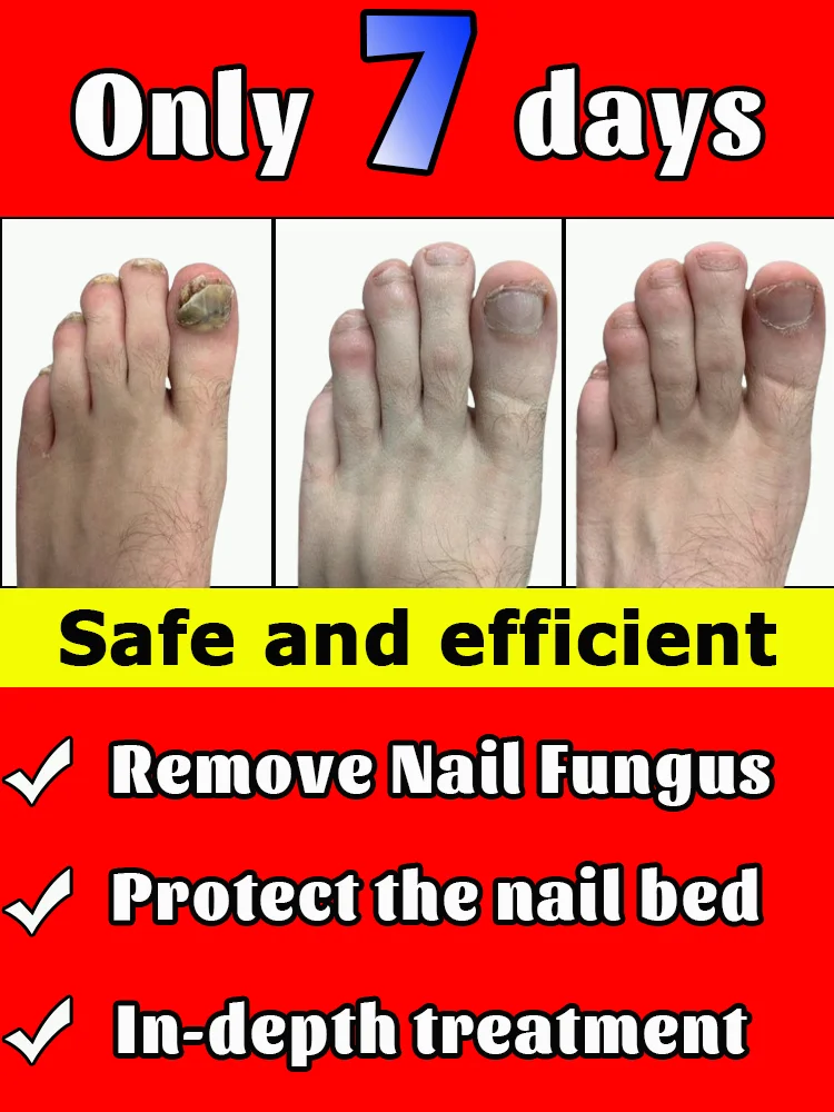 Spray per onicomicosi, facile da usare ovunque e ovunque, continua l'utilizzo e l' onicomicosi non