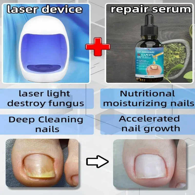 Dispositivo do laser do prego do fungo, reparo rápido do prego, unhas encravadas, cuidado do pé