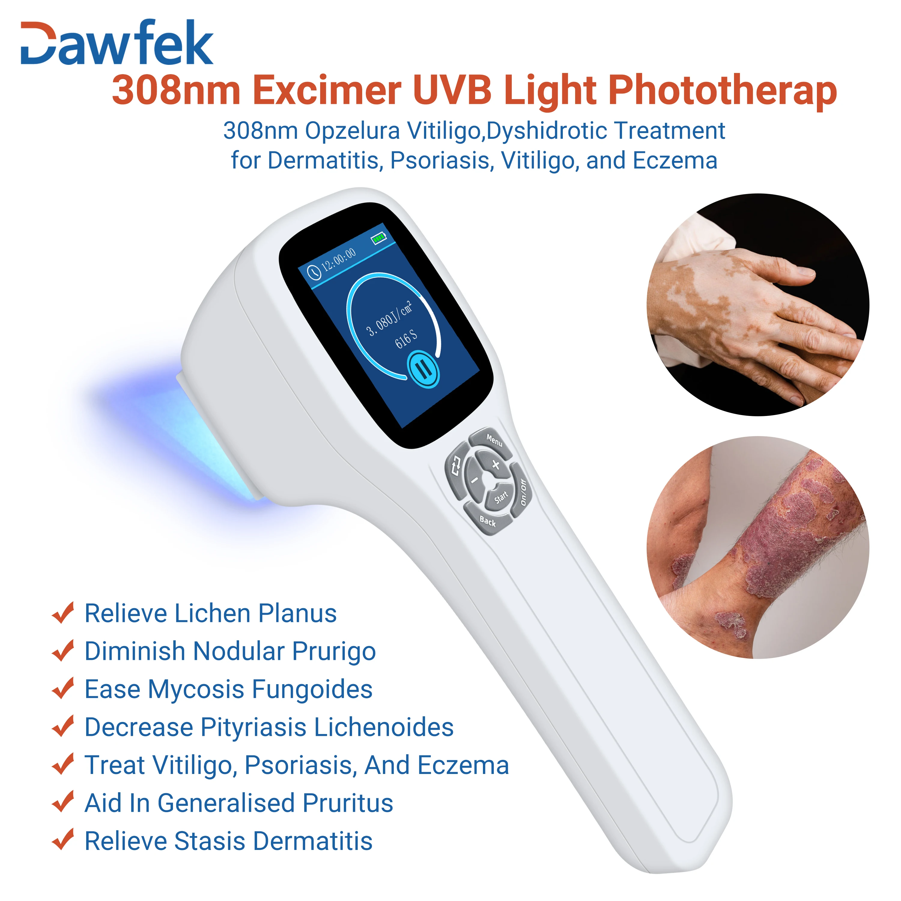 Dawfek Handheld Uvb Phototherapy Ultraviolet Light Treatment For Vitiligo For Tinea Manuum And Pedis Safe And Effective