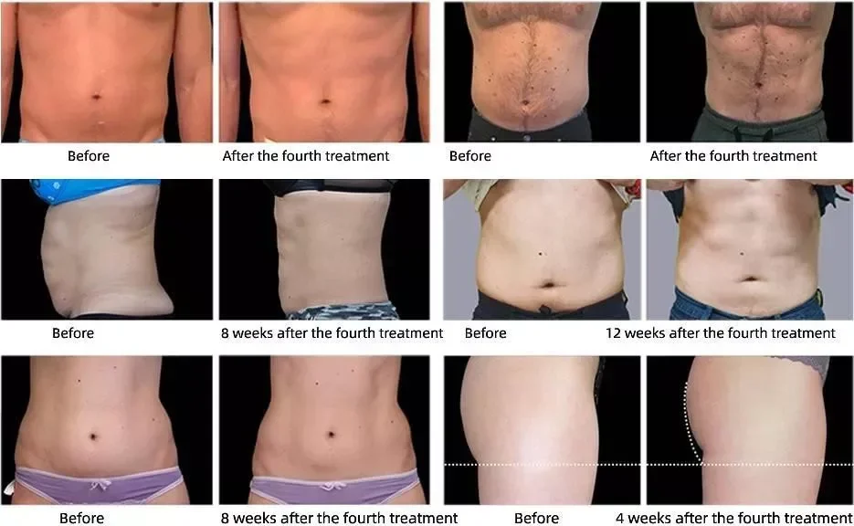 ポータブルボディスカルプティングマシン,emsミニハンドル,13テスラ,家庭用,新着,送料無料,2022