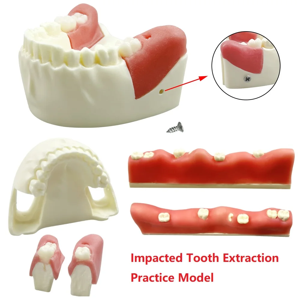 Dental Impacted Tooth Model Unerupted Tooth Extraction Practice Training Model Resin Materials Wisdom Tooth Teaching Study Model