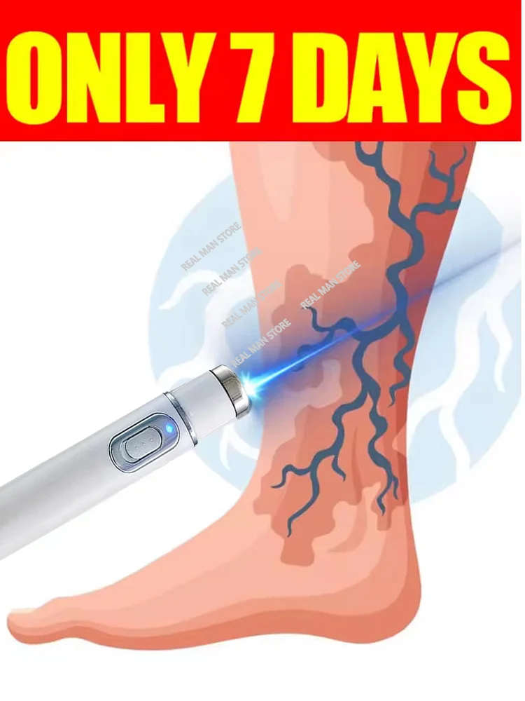 

25 Generation Varicose Vein 3nd Laser Pointer Treatment Laser used to treat varicose veins