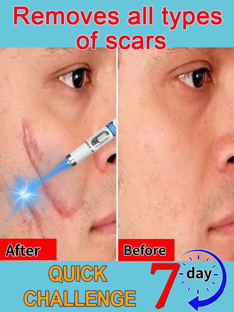 Hot Selling Laser Scar