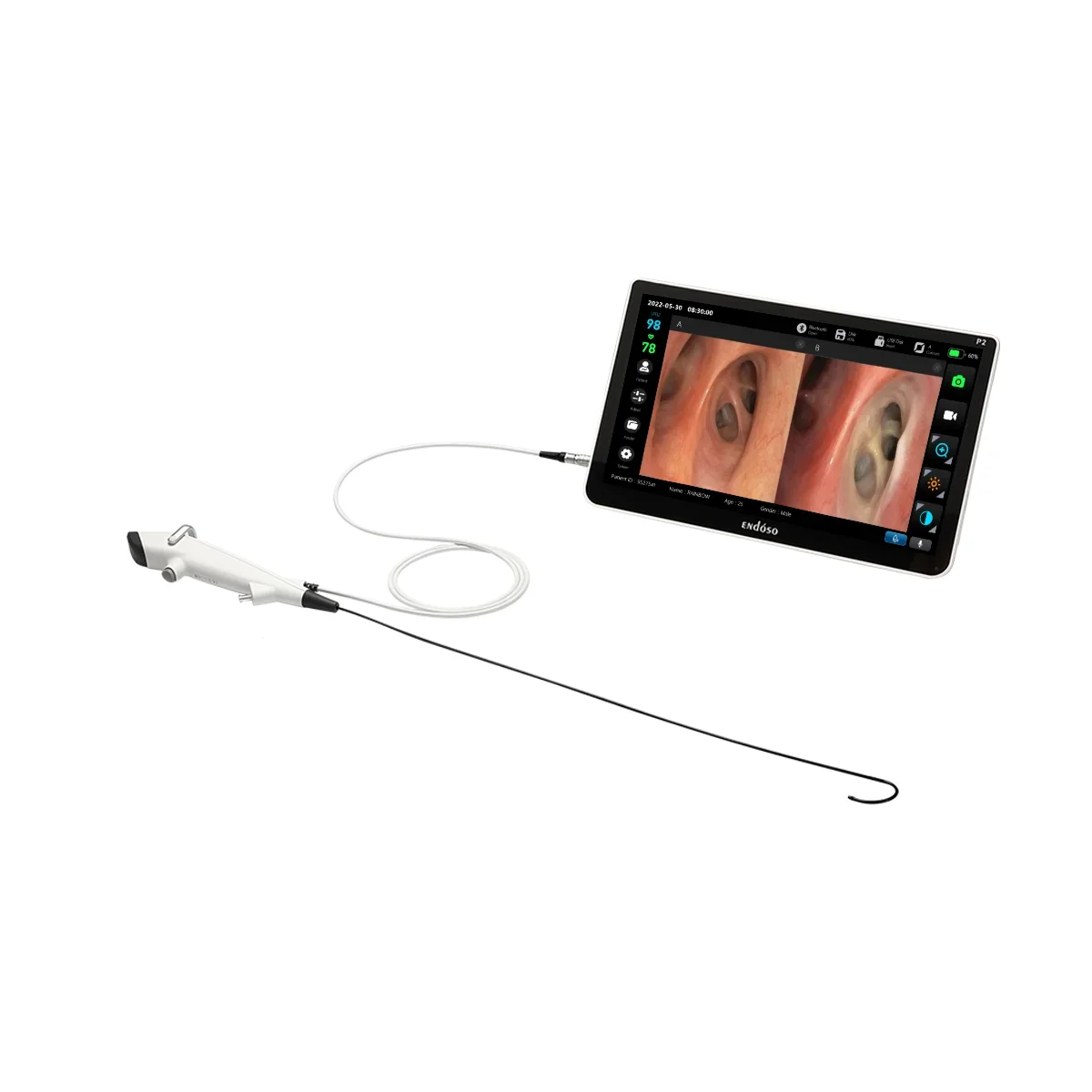 

Endoso High Quality Single Use Disposable Digital Medical Flexible 7.5Fr Ureroretroscope for Ureteroscopy Working Channel 1.2mm