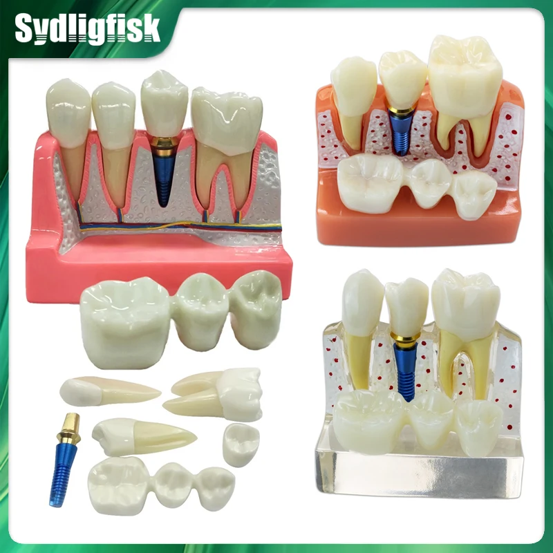 4 Times Implant Model Dental Analysis Crown Bridge Removable Model Dental Dentist Teaching Study Training Demonstration Model