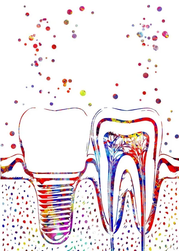 Zahnfee Aquarell – Zahnimplantat-Anatomie Rahmenloses Leinwandbild für Zahnarztpraxis Krankenhaus Klinik Dekoration 2026