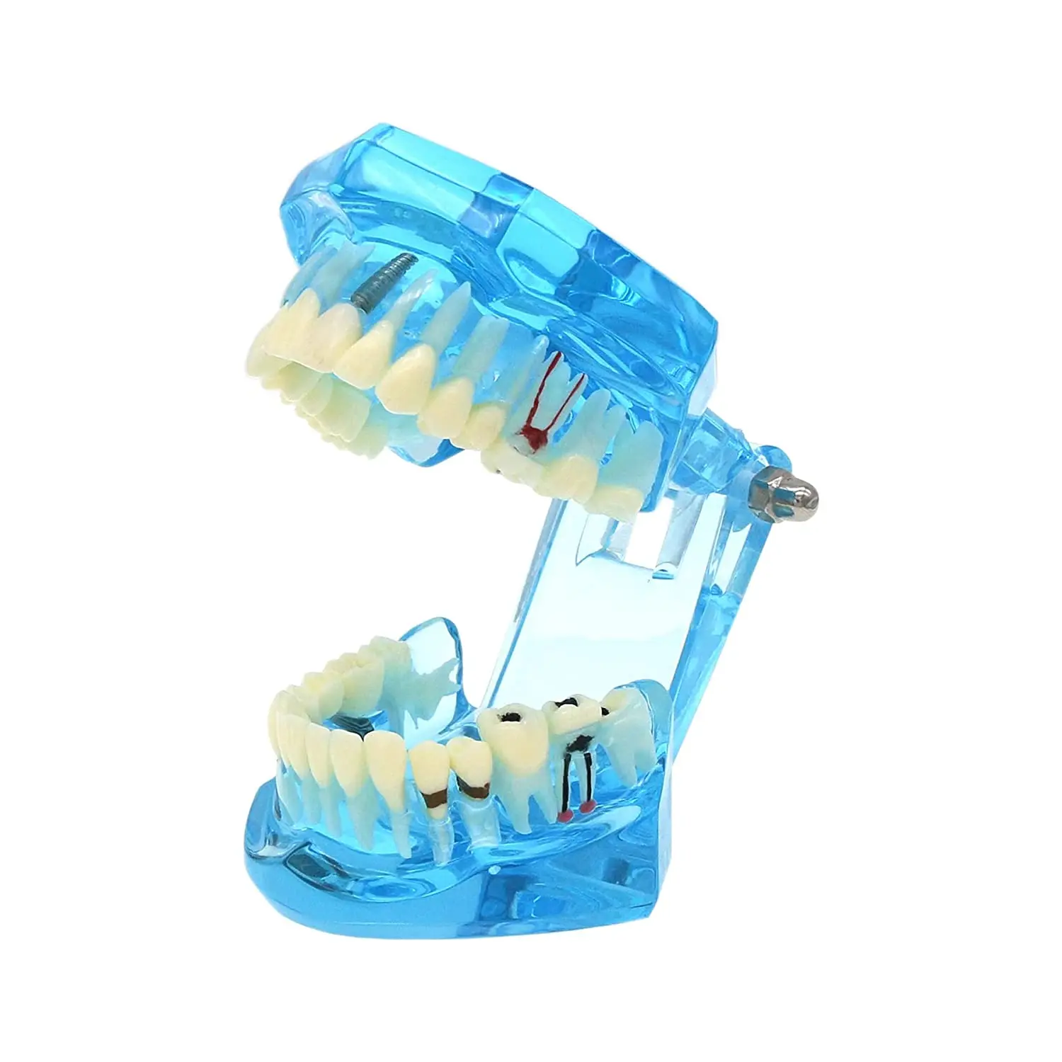 Transparent Typodont Adult Teeth Model Dental Implant Restoration Disease Pathology With Removable Teeth For Teaching Study