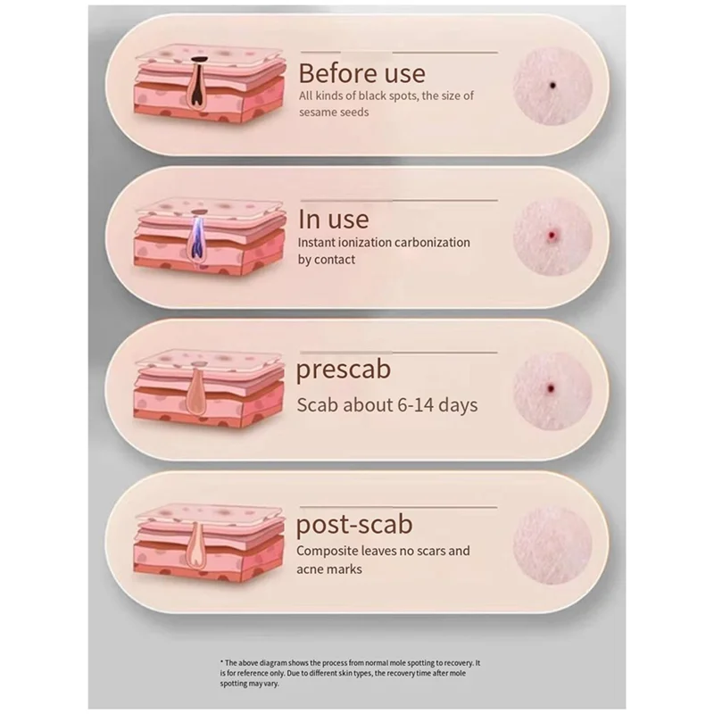 Mole Spotting Pen Laser Spotting Pen Beauty Instrument Painless Spotting Pen Silver Gray 1Set