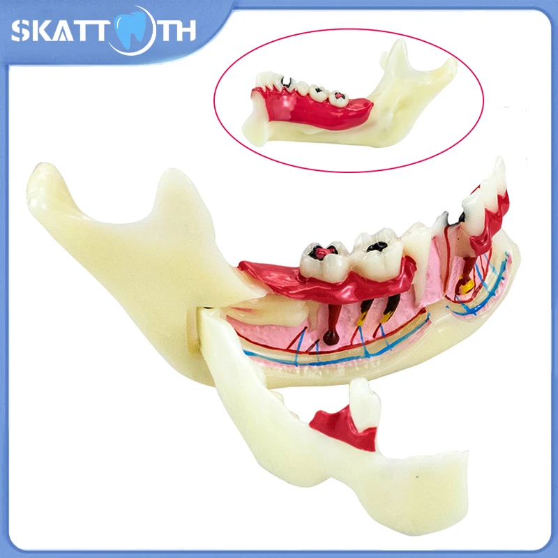 

Dental Endodontic Treatment Model Anatomy of Gums Mandible Tissue Anatomical Model Dentist Teach Study Demonstration Teeth Model