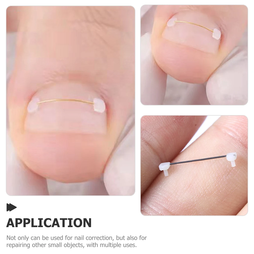 

Compact Ingrown Toenail Corrector Set 6pcs Reusable Nail Correction Wires Professional Small Tool for Foot Care 12/14/16mm