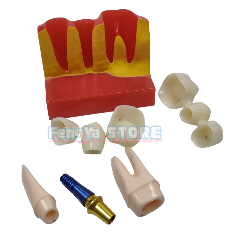  Removable 4 Times Model Typodon Implant Model Analysis Crown Bridge Demonstration Dentistry Study Communication Teeth Model
