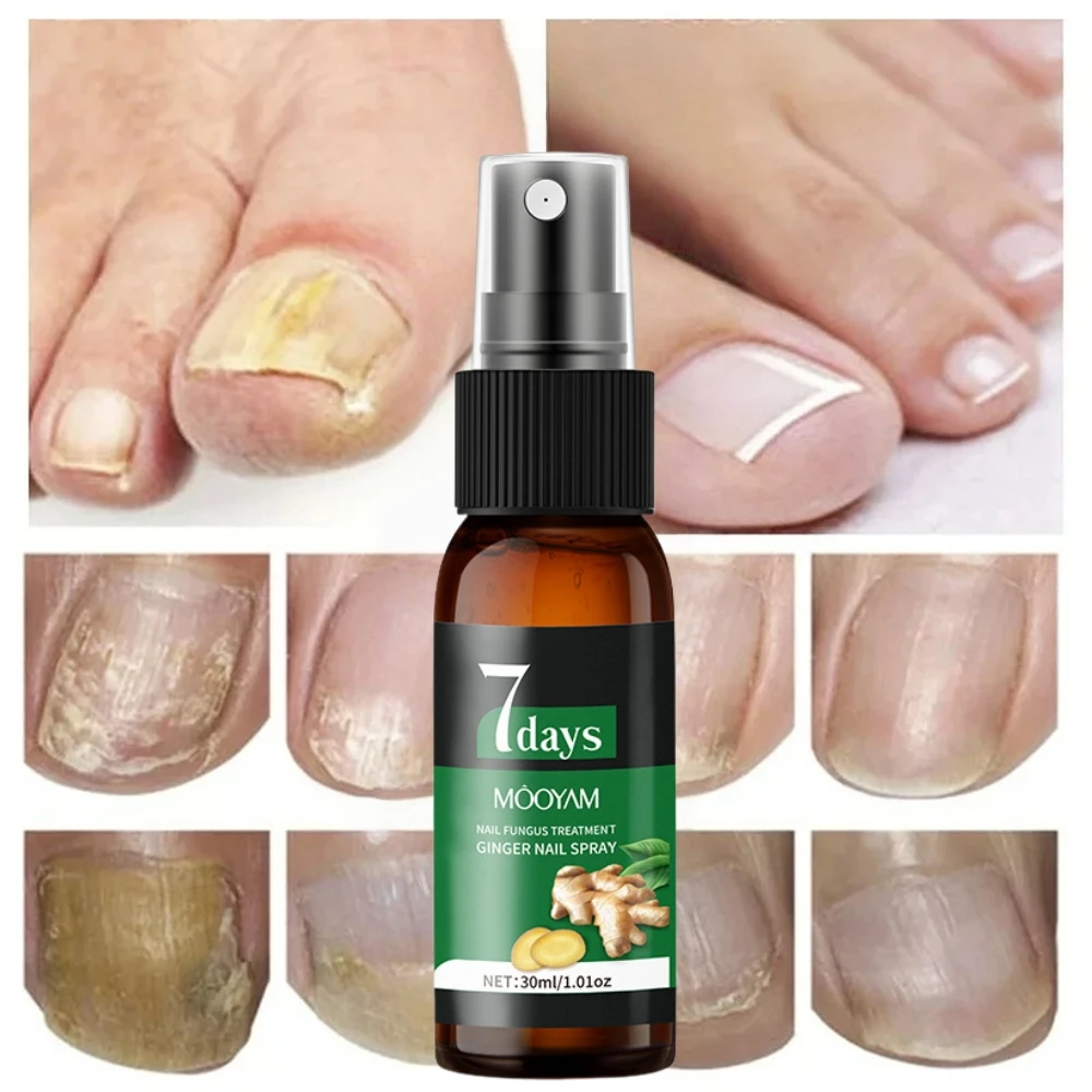 Sérum de traitement des champignons des ongles, 7 jours, élimination des champignons des orteils, Essence Anti-Infection, Onychomycose, Paronychia, produits de soins des ongles