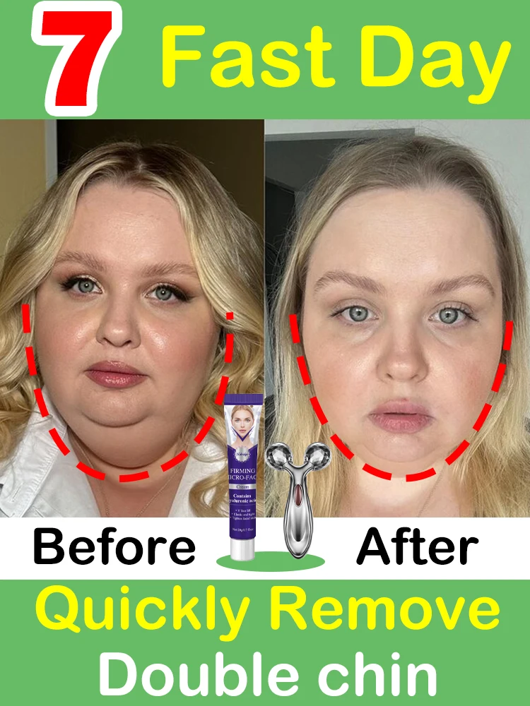 

Double chin removal V lift