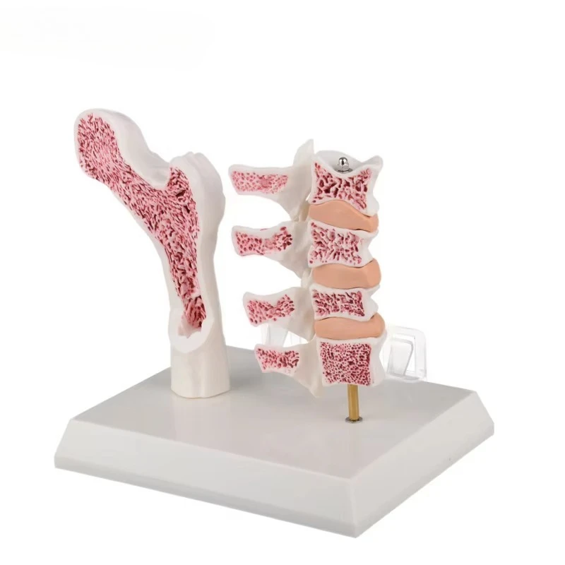 Osteoporosis Model of Femur and Lumber Bone Fracture Anatomy Model for Medical Science Classroom Education
