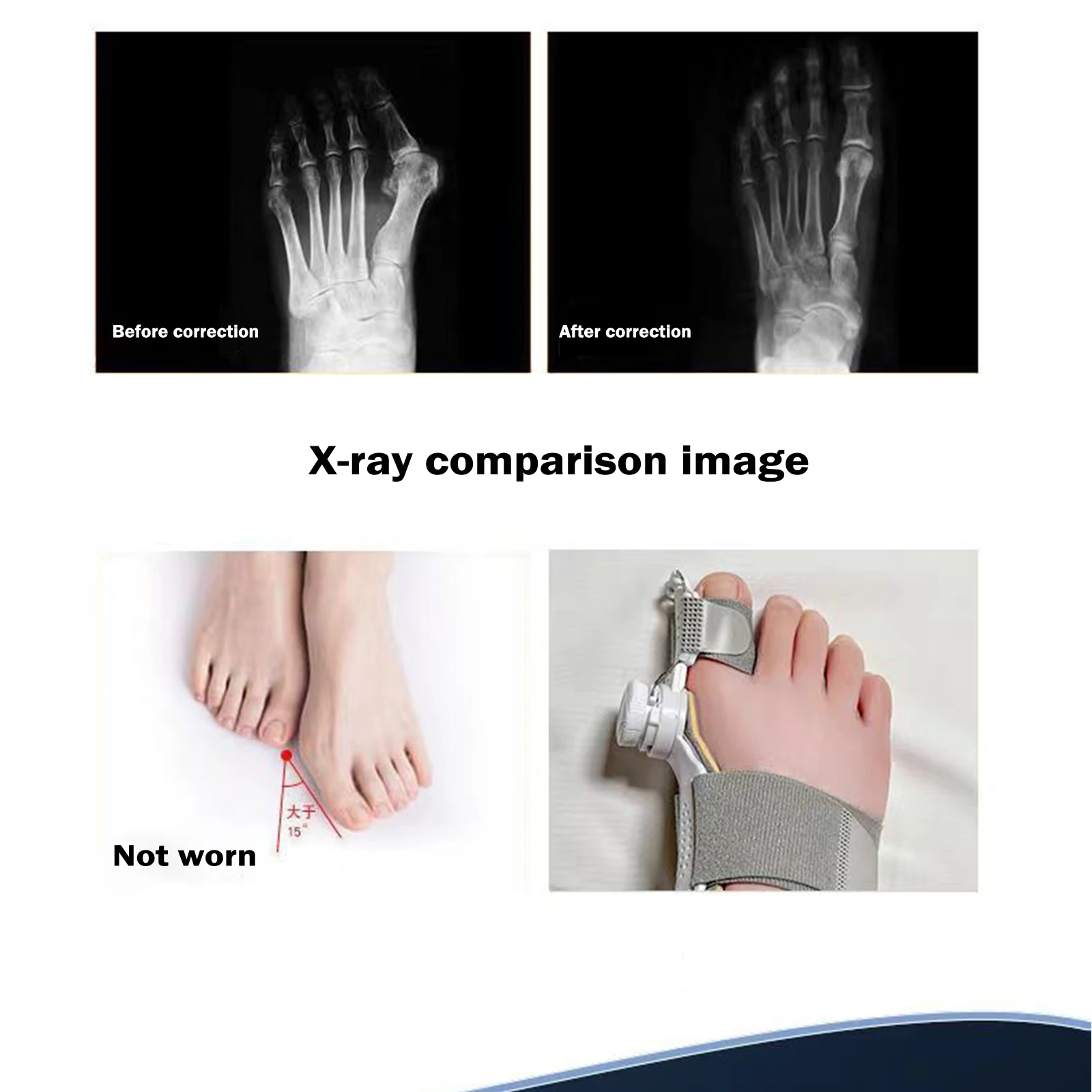 Knob-type Thumb Valgus Improvement And Correctionartifact Separated Toe Corrector Adult Unisex Orthopedic