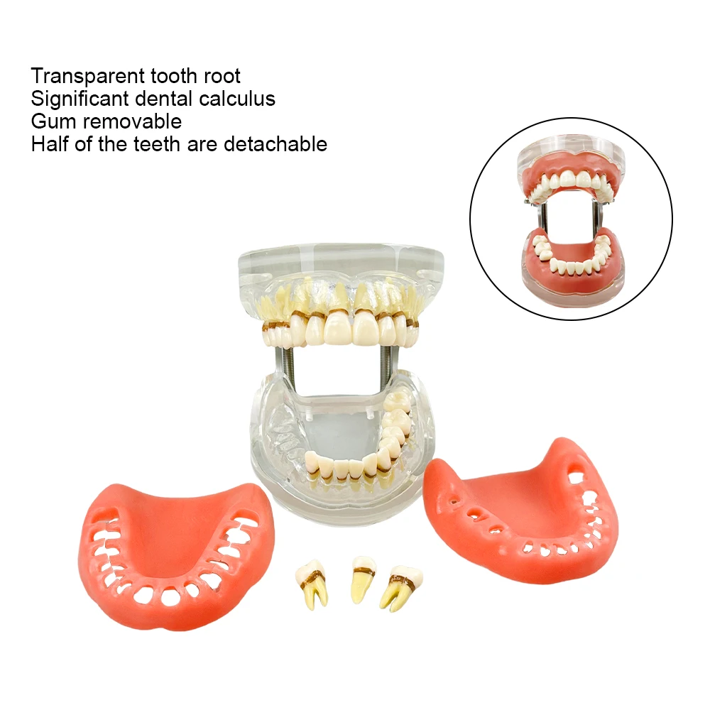 Impacted Wisdom Teeth Dental Model Silicone Gum 3 Detachable Teeth Pathological Periodontal disease for Oral Teeth model