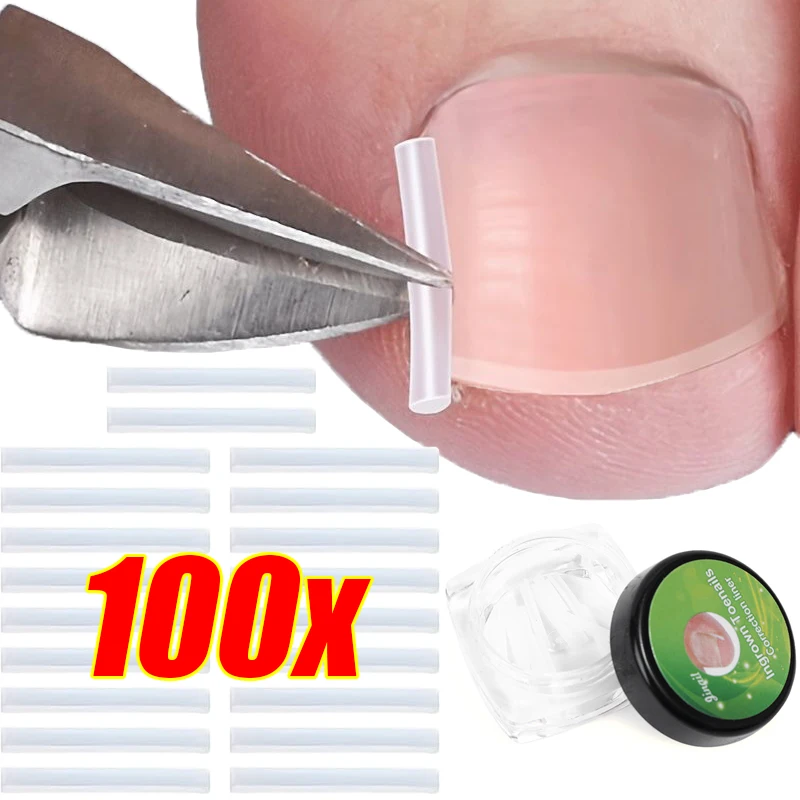 1/10 Box Elastic C-shaped Tube Pad Treatment Invisible Groove Straightening Clip Ingrown Toenail Corrector Tools Foot Care