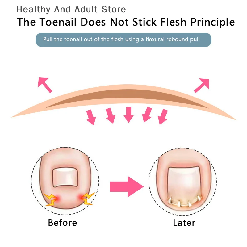 Professional Ingrown Toenail Corrector Tools Pedicure Recover Embed Toe Nail Treatment Ingrown Toenail Correction Foot CareTool