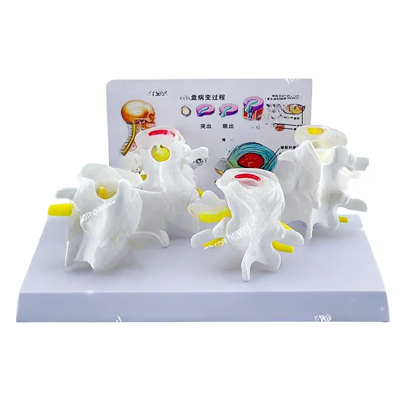 

Four Types of Normal Spine and Pathological Lumbar Spine Combination Model Pathological Disc Lumbar Spine Demonstration