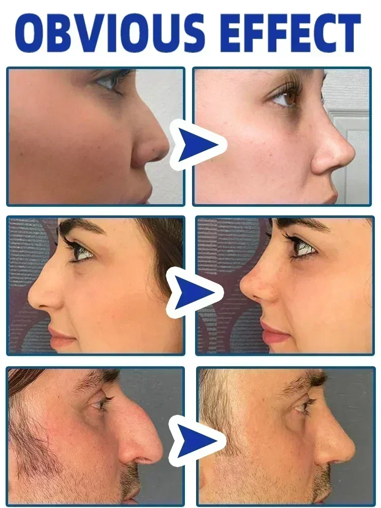 Nose Lift Up Heighten Rhinoplasty Oil  Heighten Rhinoplasty Nasal Bone Remodeling Pure Natural Care Thin Smaller Nose