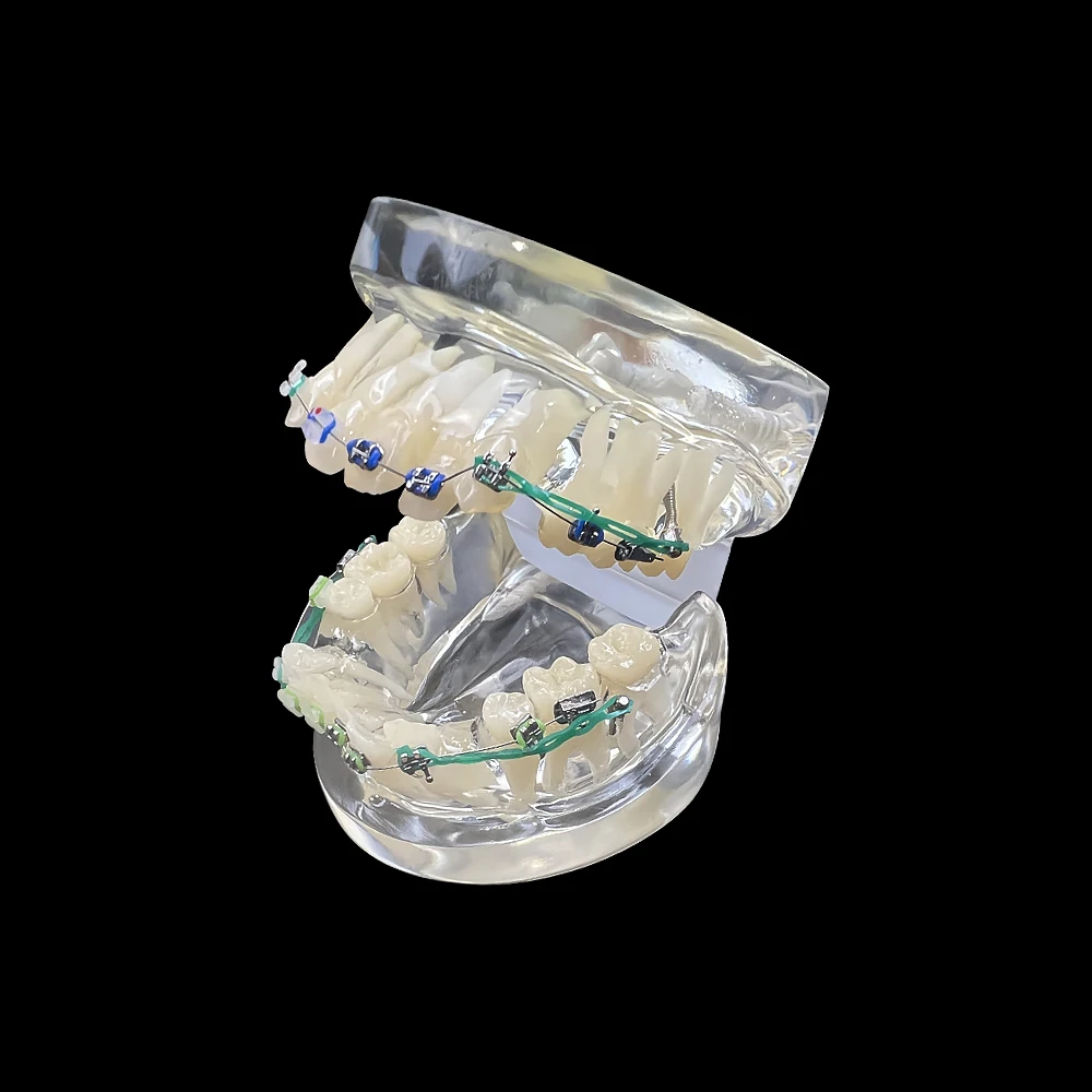 Dental Typodont modello di denti ortodontici con staffe in metallo e ceramica bretelle fascette a catena modelli di trattamento odontoiatrico con filo ad arco