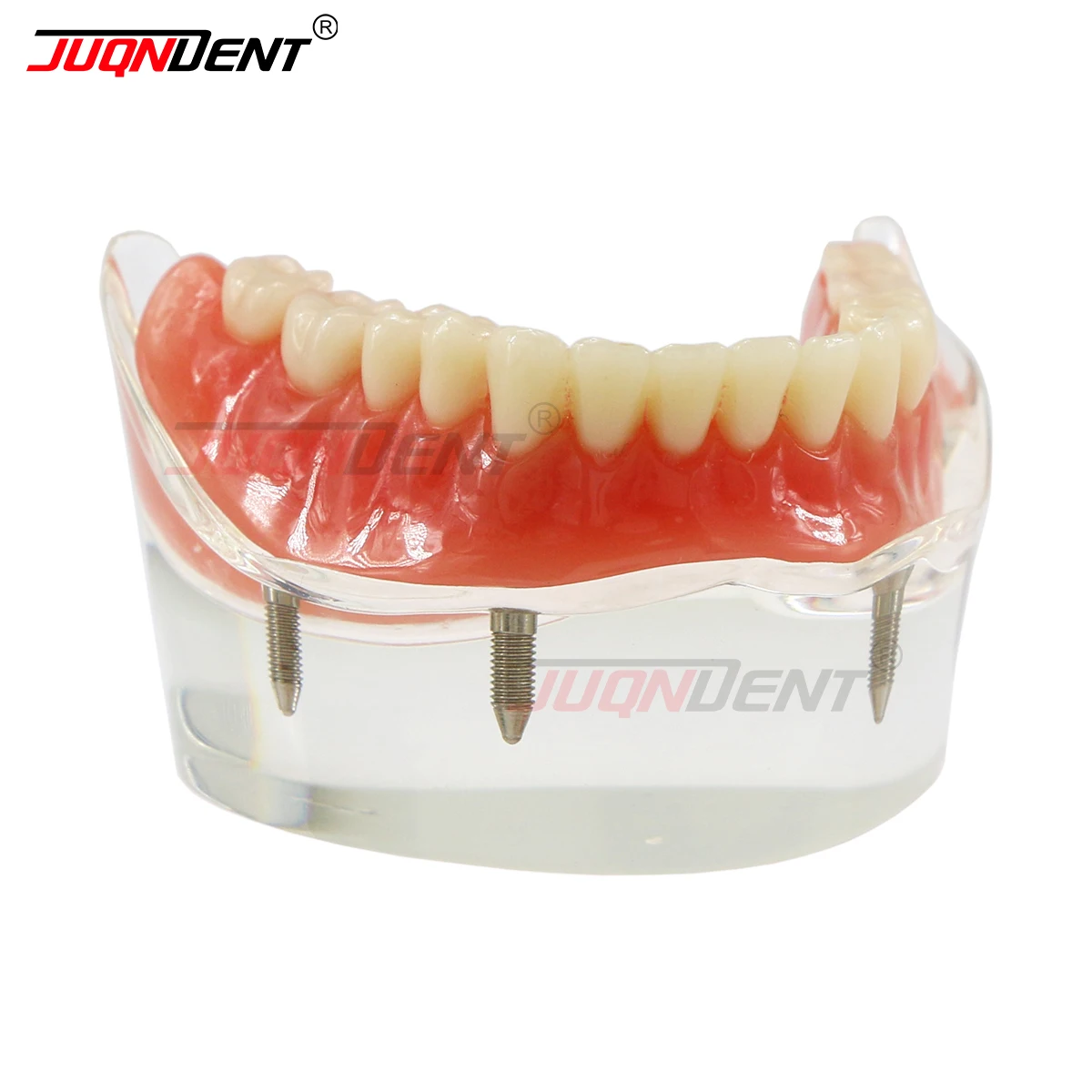 Dental Teeth Model 4 Upper Overdenture Superior Dental Model For Dentist Patient Demo Explain Implants Functioning