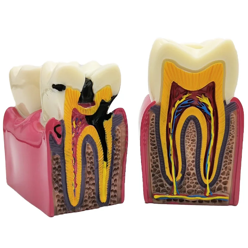 8 Times Dental Caries Model Disease Teeth Dental Model for Dental Demonstration Model Dentist Teaching Dental Lab Oral Research