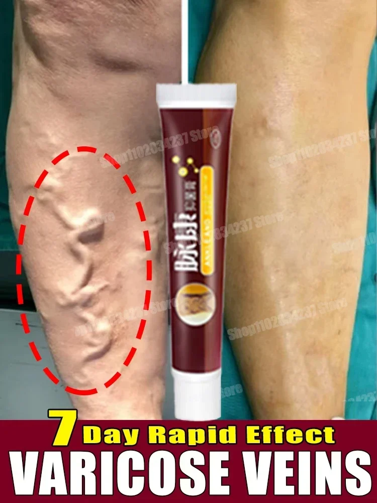 

Varicose Vein Cream Leg Health Care