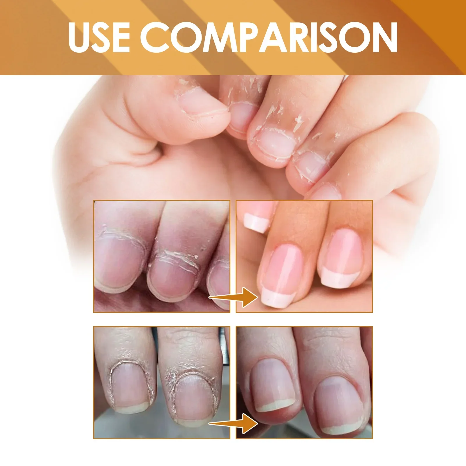 Nagelhautentfernungsgel, professionelle Nagelhaut, reduziert abgestorbene Haut, Nagelwachstum, stärkt das Peeling, sanftes, effektives Nagelweichmaßgel