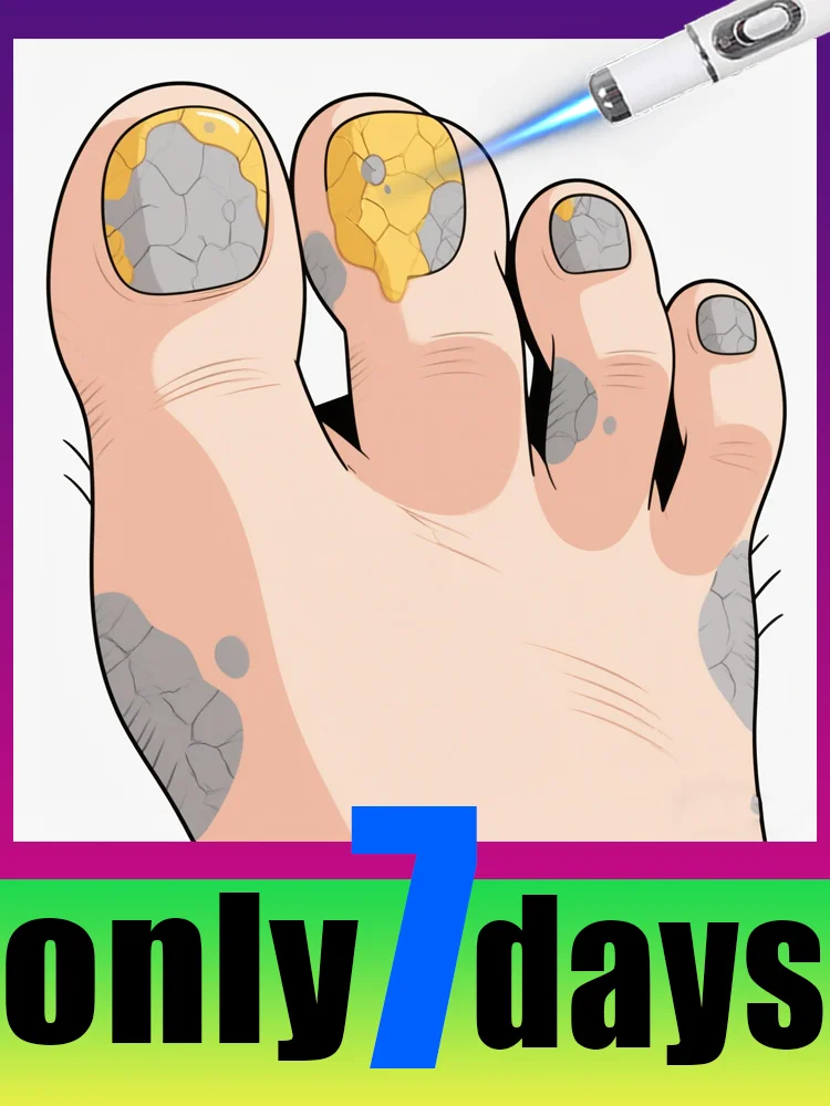 

2025 hot sell Nail care tools to fight fungus get rid of onychomycosis blue Laser pen