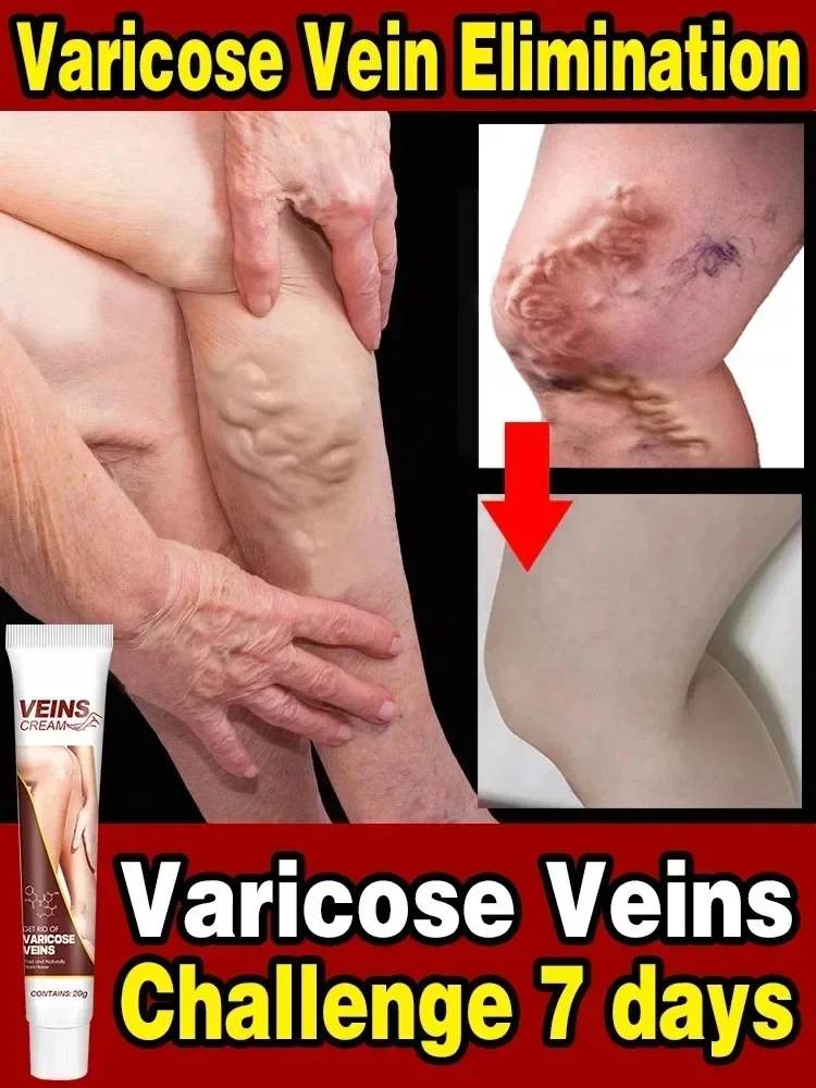 Varicose Vein Relief Paste Improve Blood Circulations Spider Varicose Vein For Tired Heavy Legs Fast Relief New