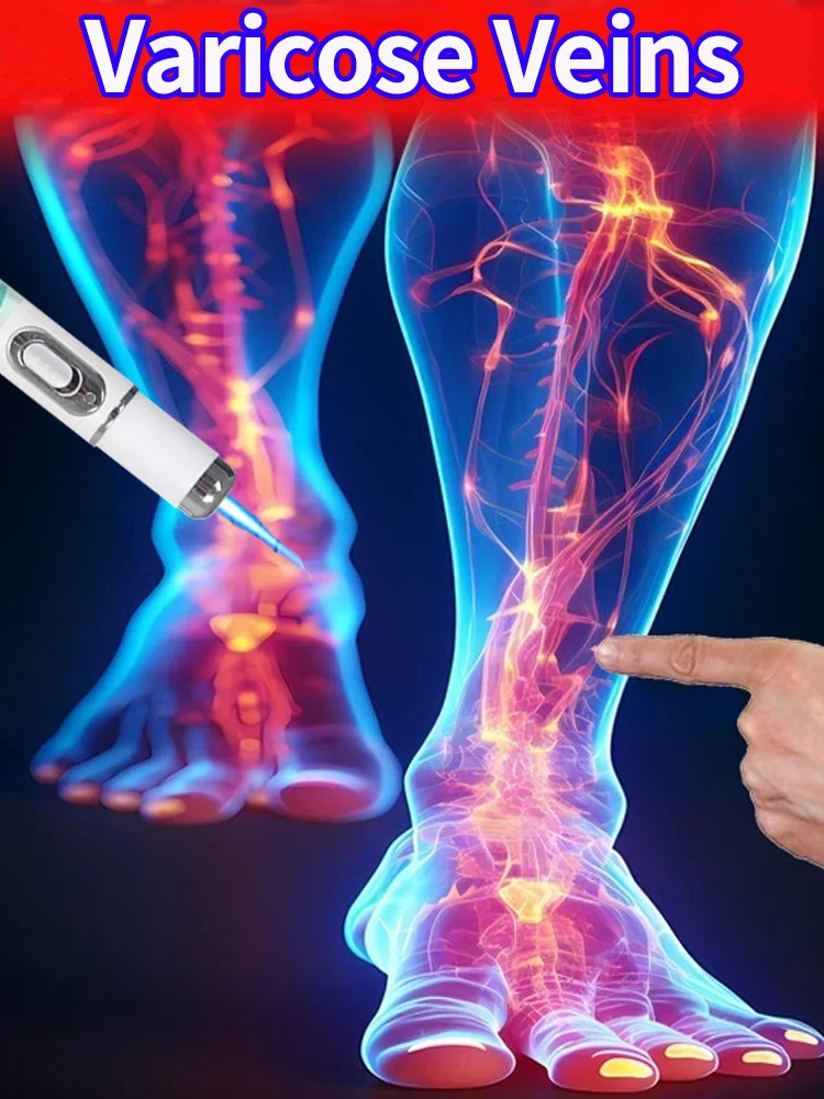

Generation-2 Laser Save Varicose Veins Spider Legs in 7 Days for Men Women All People