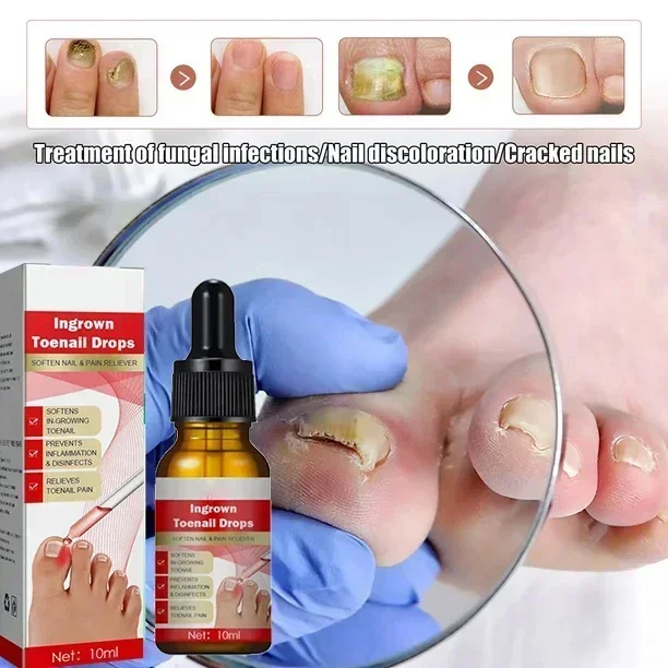 Extra Strong Nail Fungus piedi unghie riparazione cura Anti infezione Toe rimozione fungina nuovo