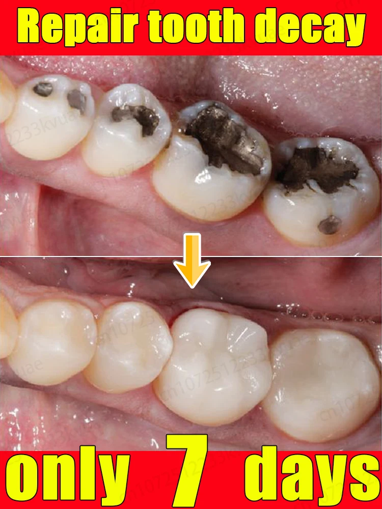 Dentifrice réparateur de carie, répare les caries, blanchit les dents, rafraîchit l'haleine