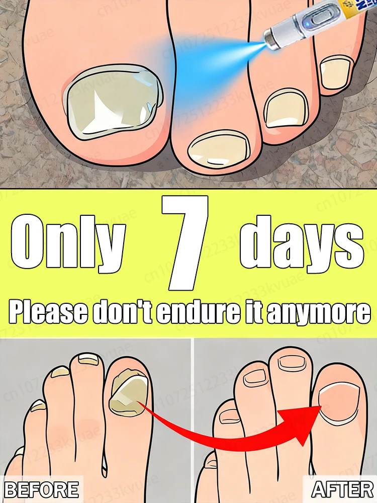 

Get rid of onychomycosis in 7 days. No recurrence, no nail damage.