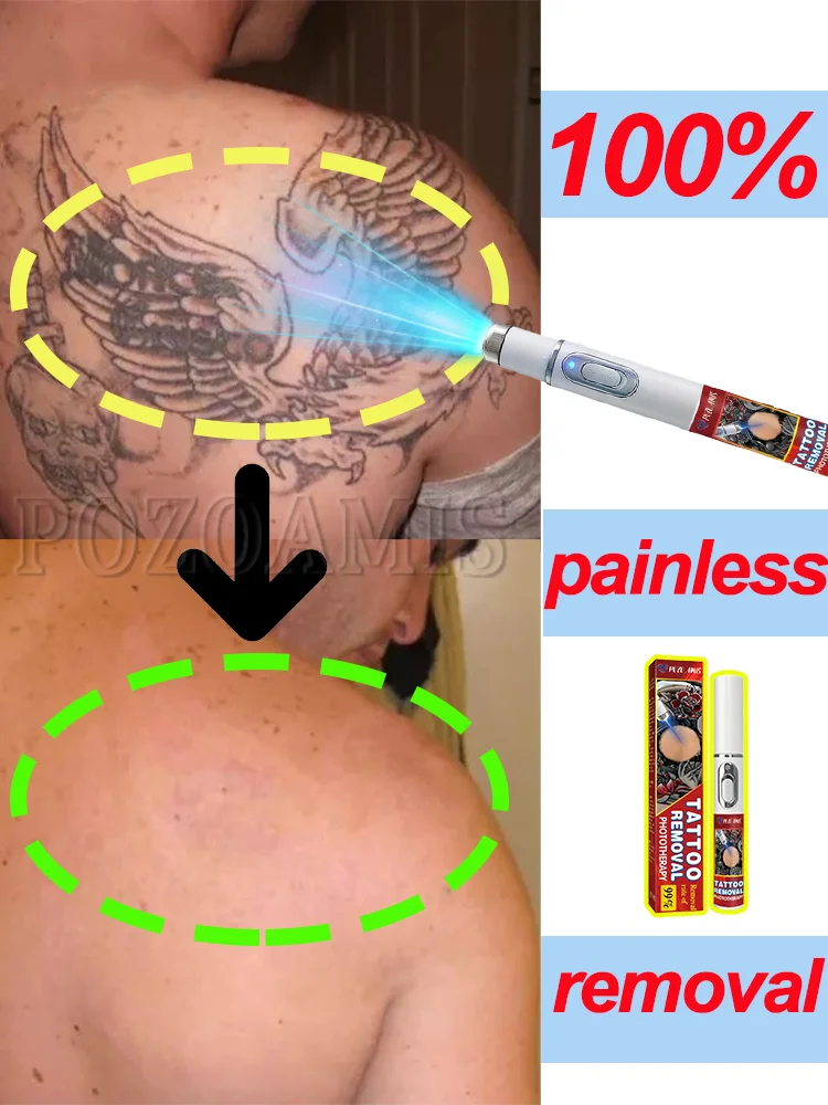 Deep cleaning of tattoos, decomposition of pigmentation, tattoo disappearance