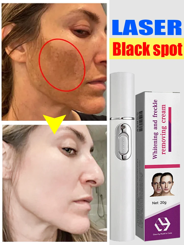 

Laser Dark Spots Melasma Freckles Face Whitening