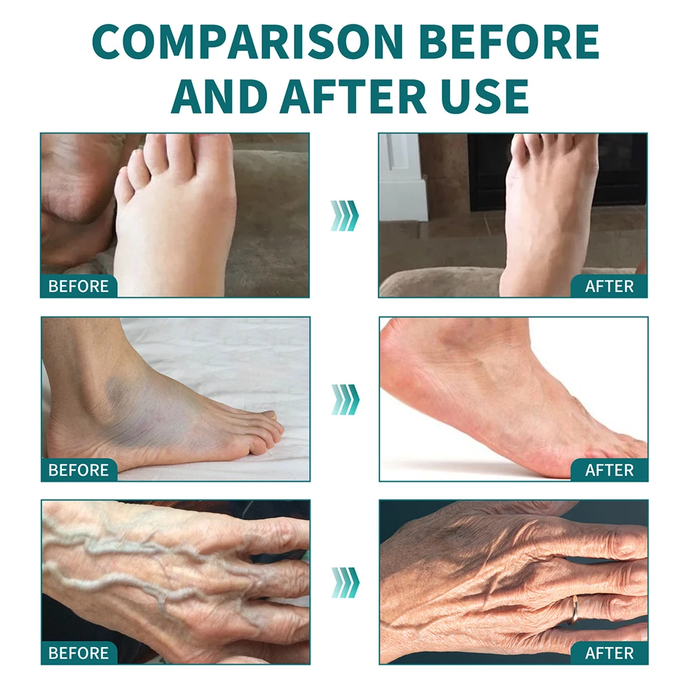 Neuropathy Hand Foot Numbness Relief Cream Deep Penetrating Strengthen Blood Circulation Finger Joint Relief Treatment