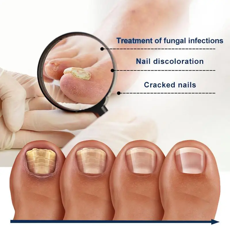 Portátil Toe Nail Tratamento Pen, Renovação unha, Reparação Eficaz, Cracking descolorido