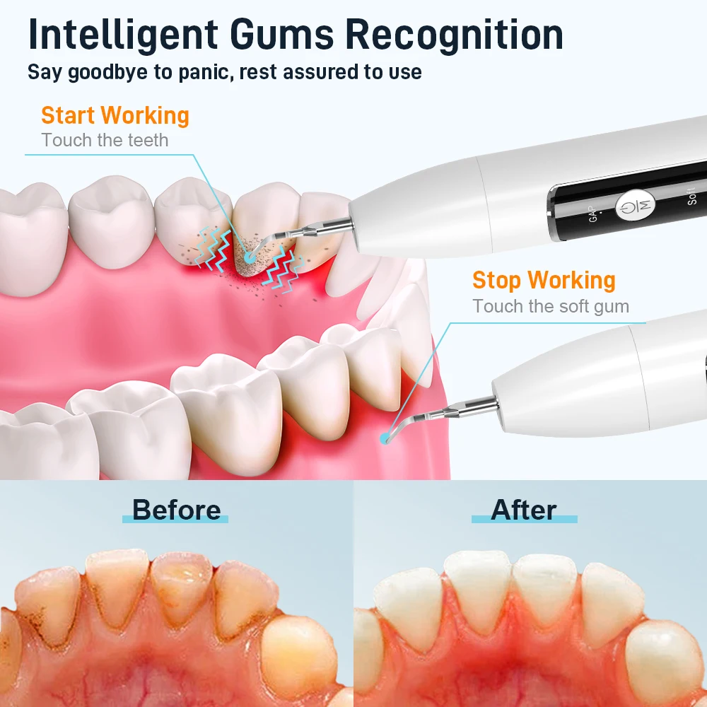 Schoben-Dental escarificador ultrasónico para dientes, removedor de cálculo Dental Para manchas de sarro, limpiador de placa Dental sónico