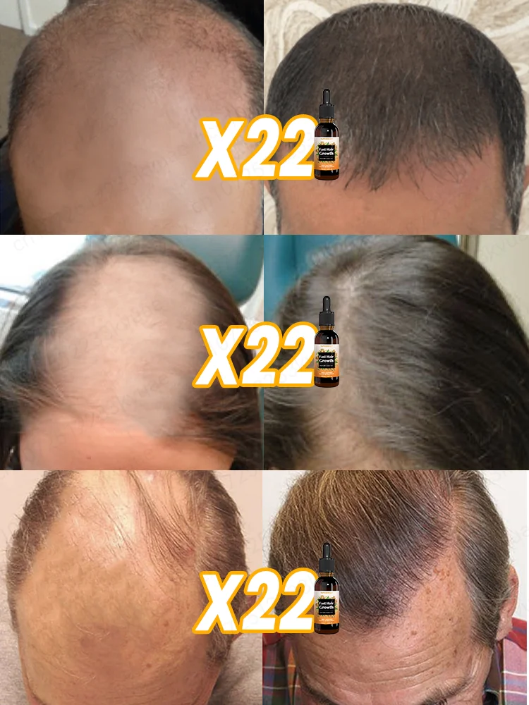 Aɴᴛɪ ʜᴀɪʀ ʟᴏss, ʜᴀɪʀ ғᴀsᴛ ɢʀᴏᴡᴛʜ ɴᴜᴛʀɪᴛɪᴏɴ ᴇssᴇɴᴄᴇ