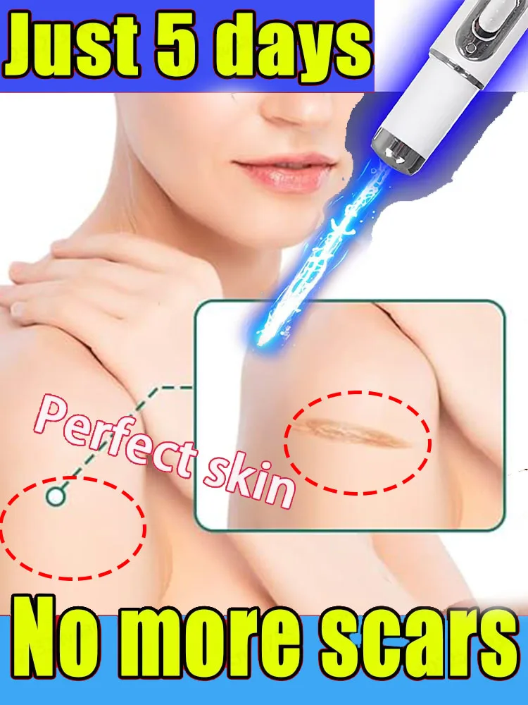 

Unisx Blue light laser pen Keep applying for long time and the scars will disappear